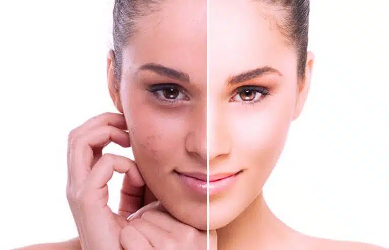 microdermoabrasion contra el acne