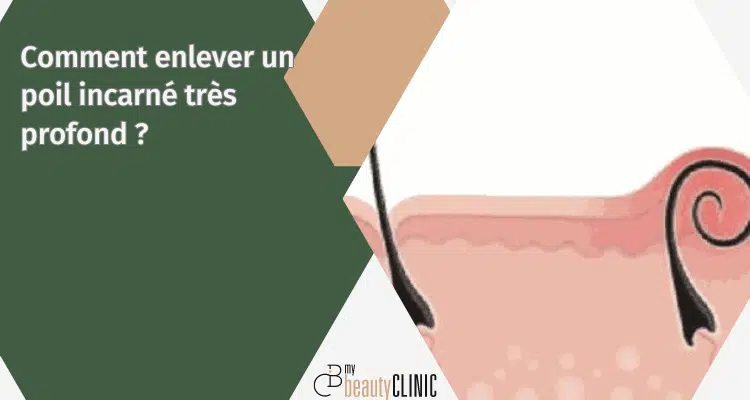 Comment enlever un poil incarné très profond ? 1 Comment enlever un poil incarné très profond