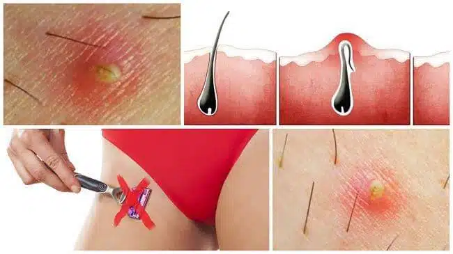 Comment Prévenir et Traiter les Poils Incarnés sur le Pubis : Guide Complet 2 poil incarne sur le pubis