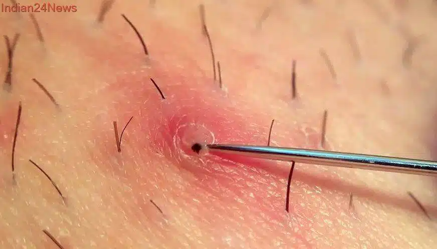 Comment Prévenir et Traiter les Poils Incarnés sur le Pubis : Guide Complet 3 poil incarne