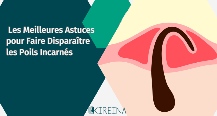Les Meilleures Astuces pour Faire Disparaître les Poils Incarnés